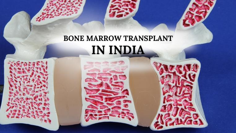 bone marrow transplant in india